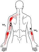 Stock Illustration Of Triceps Brachii And Anconeus Mm113018 - Search 